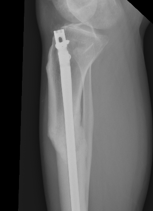 Proximal Tibial Malunion